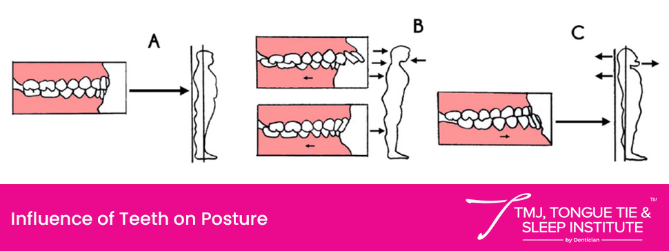 Influence of Teeth on Posture Influence of Teeth on Posture
