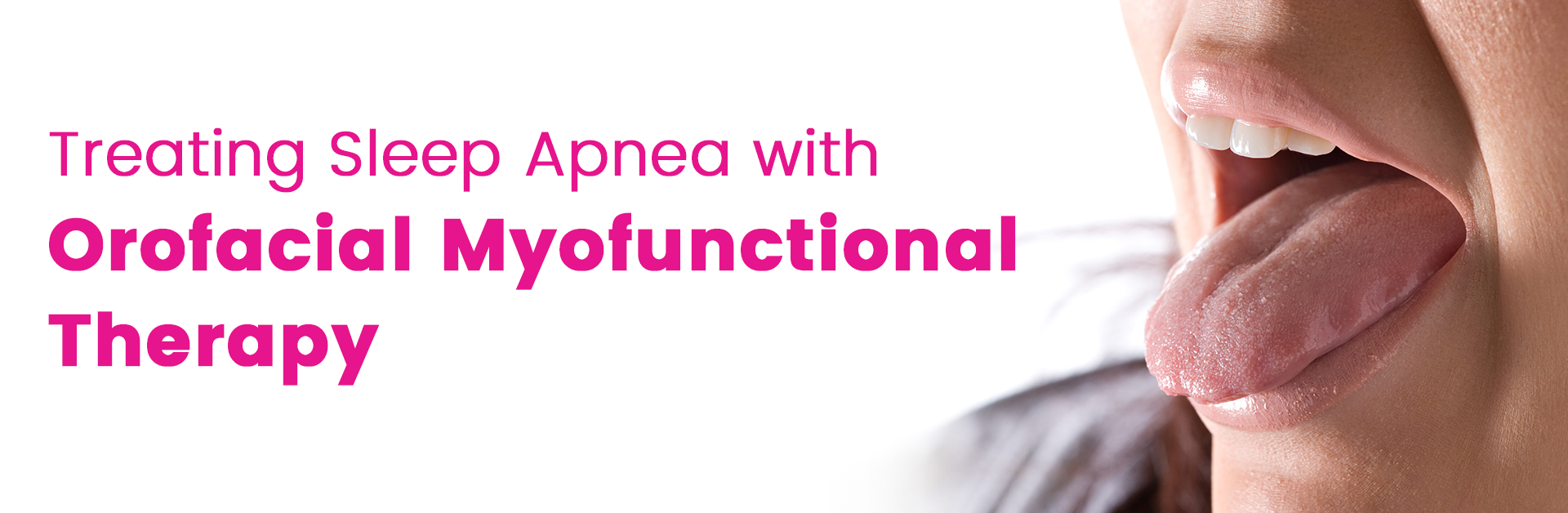 TREATING SLEEP APNEA WITH OROFACIAL MYOFUNCTIONAL THERAPY