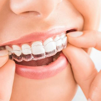 Invisible Braces like Invisalign or Aligners