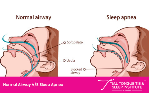 normal airway vs sleep apnea normal airway vs sleep apnea