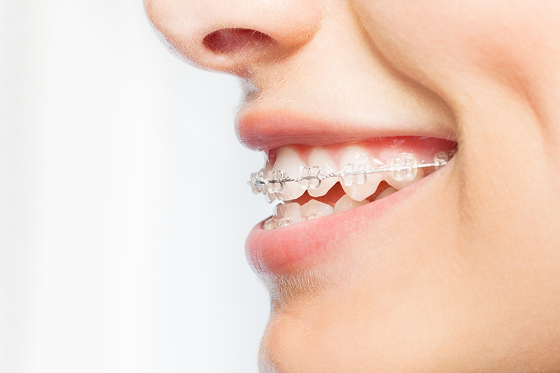 Ceramics Braces