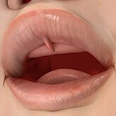 Lip tie in toddlers Lip tie in toddlers