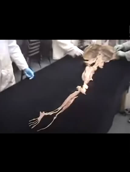 frenuloplsty video