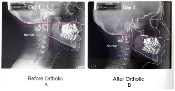 spine posture without and without orthotic spine posture without and without orthotic