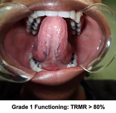 grade 1 functioning trmr grade 1 functioning trmr