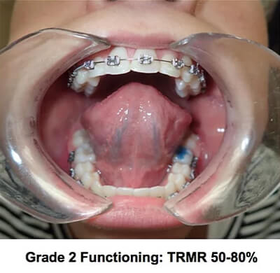 grade 2 functioning trmr grade 2 functioning trmr