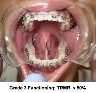 grade 3 functioning trmr grade 3 functioning trmr