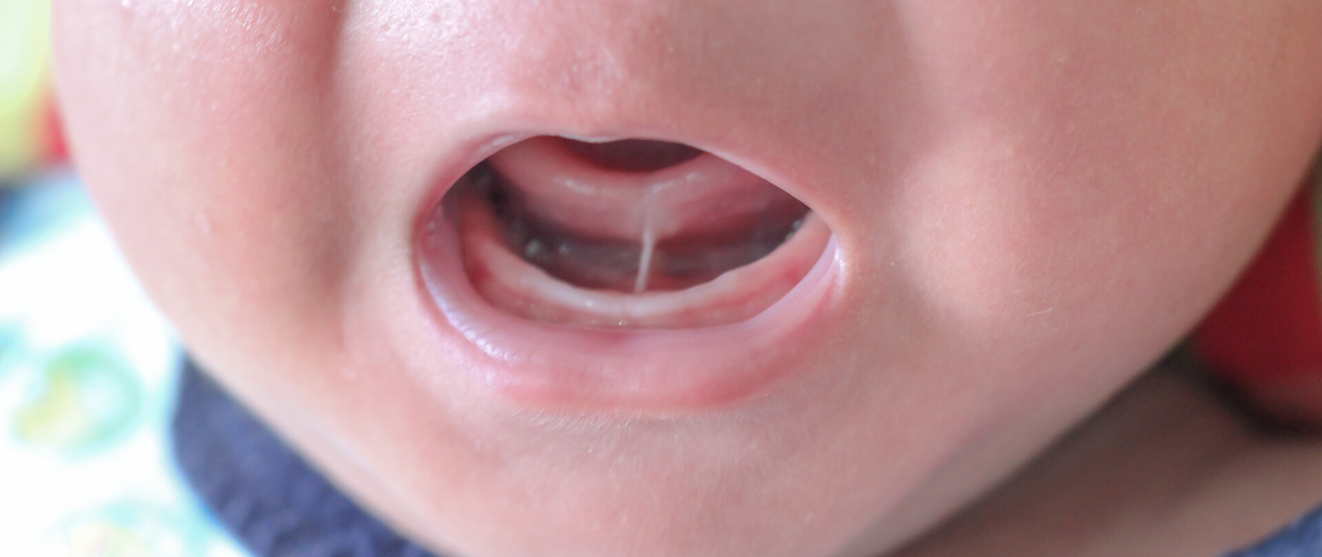 ankyloglossia, latching, breastfeeding, colic