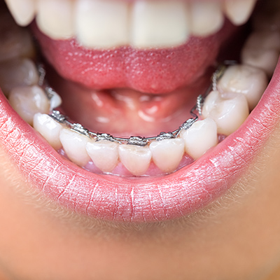 Lingual Orthodontics