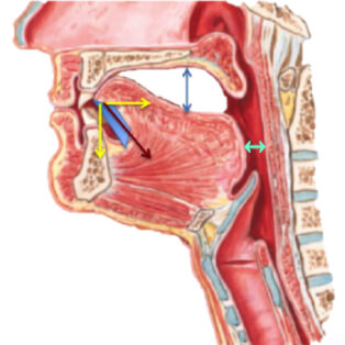 low tongue posture tongue blocking airway low tongue posture tongue blocking airway