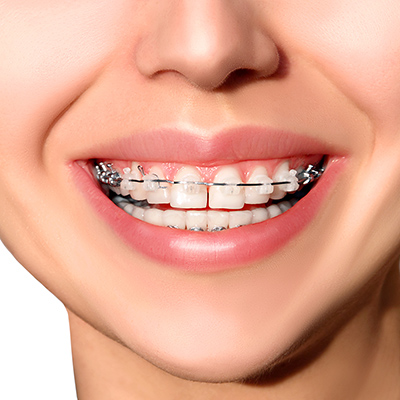 metal ceramic damon braces