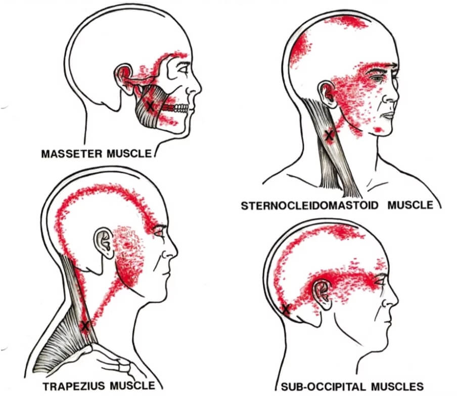 MYOFACIAL REFERRAL PATTERNS OF PAIN MYOFACIAL REFERRAL PATTERNS OF PAIN