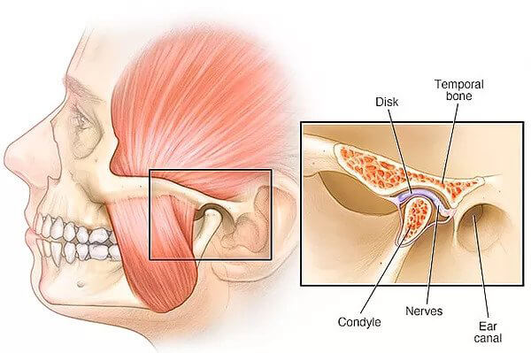Temporomandibular Joint Disorder Temporomandibular Joint Disorder