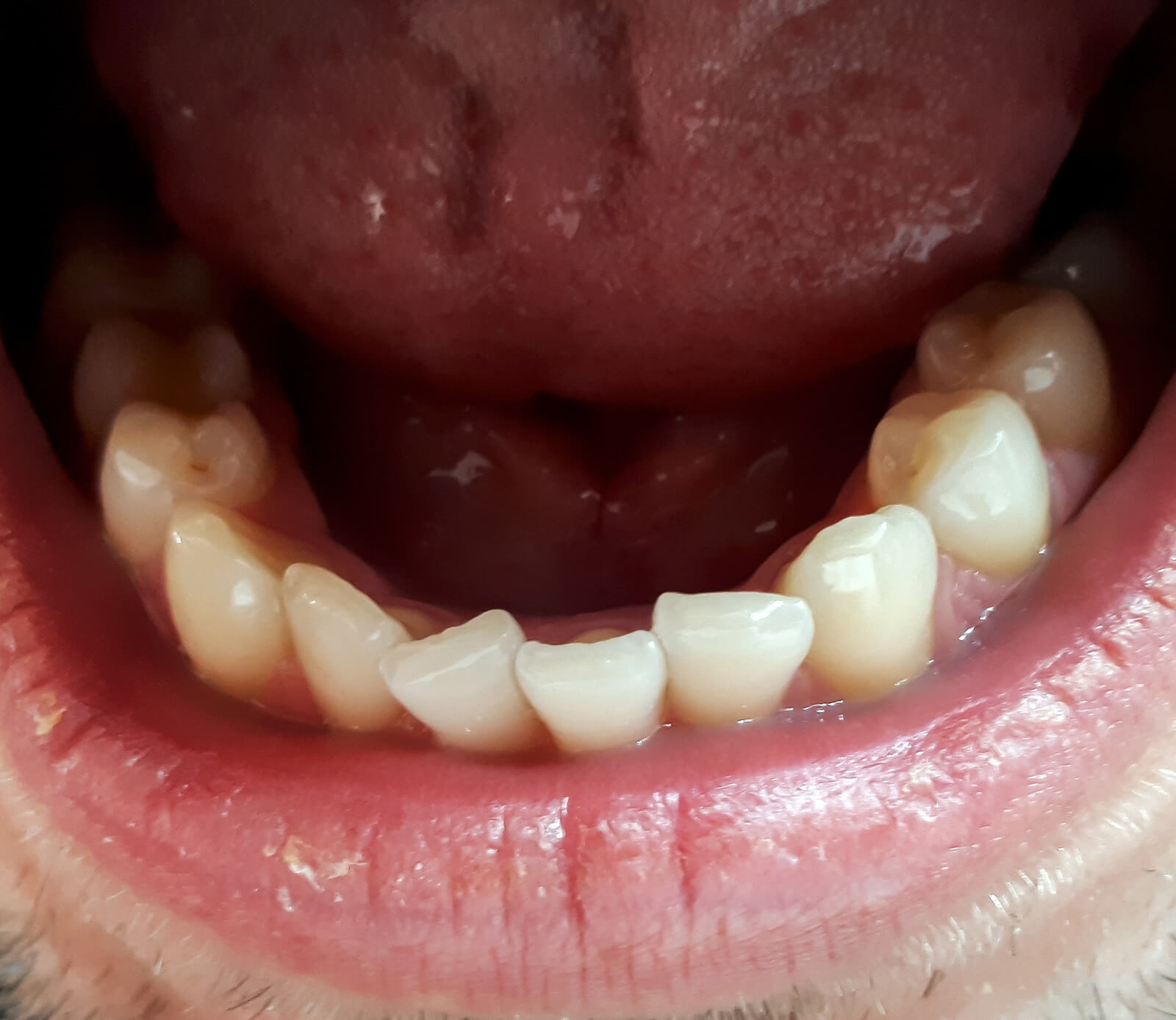 to correct teeth crowding