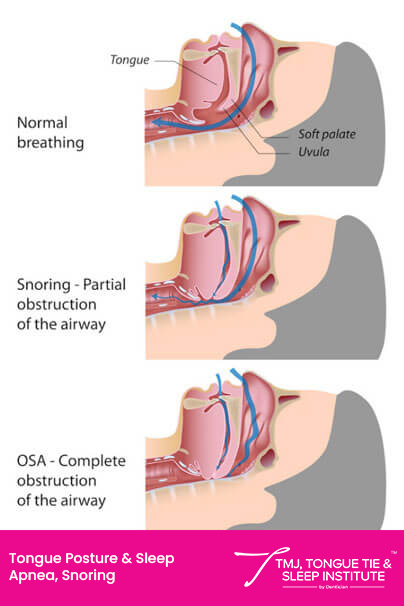 Tongue Posture & obstruction Tongue Posture & obstruction