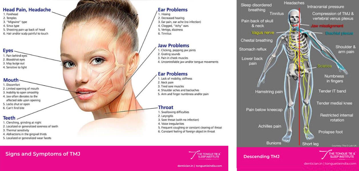 TMJ Occlusion Posture and Airway